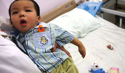 脱细胞异体真皮应用于小儿肛瘘