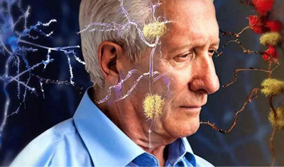 人工智能应用于临床影像的数据分析能预测早期老年痴呆 人工智能应用于临床影像的数据分析能预测早期老年痴呆